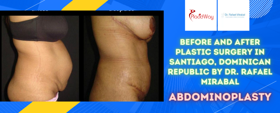 Before and After Abdominoplasty Surgery in Santiago, Dominican Republic