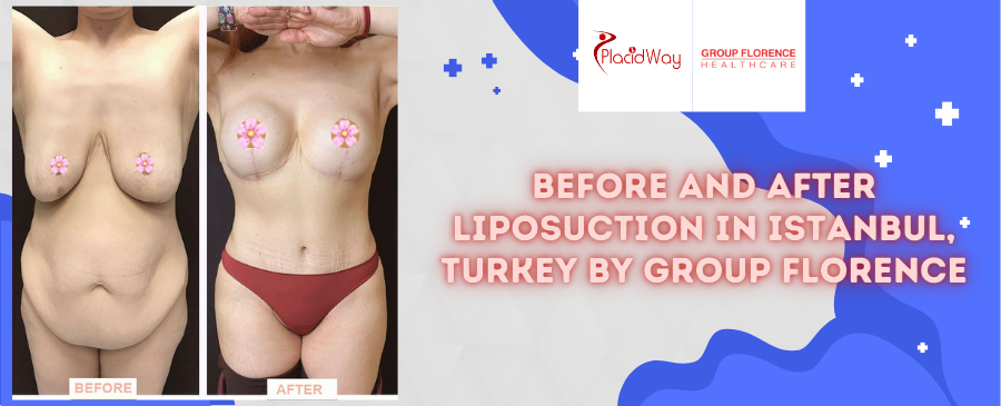 Before and After Liposuction in Istanbul, Turkey by Group Florence