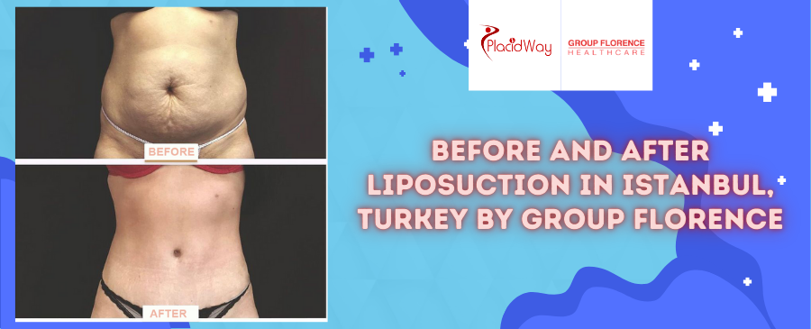 Before and After Liposuction in Istanbul, Turkey by Group Florence