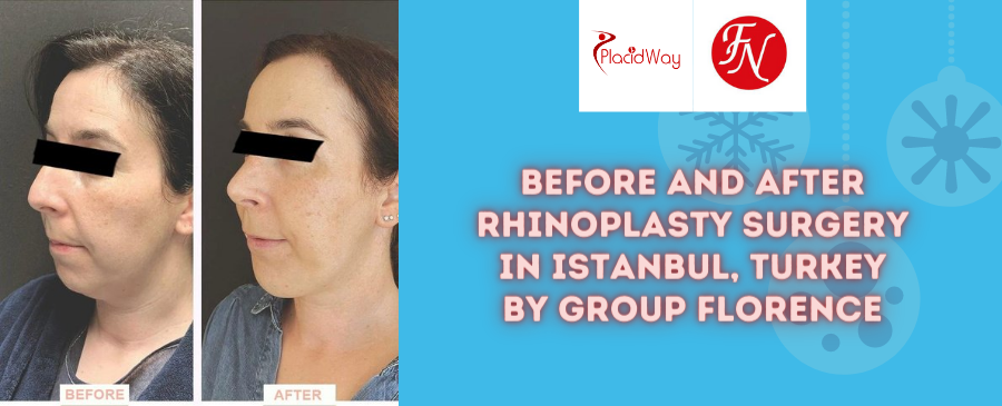 Before and After Rhinoplasty in Istanbul, Turkey by Group Florence