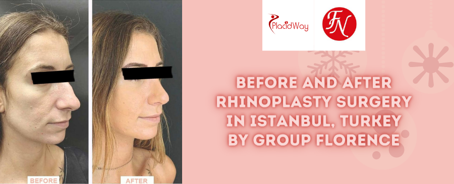 Before and After Rhinoplasty in Istanbul, Turkey by Group Florence