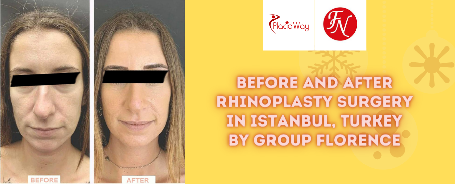 Before and After Rhinoplasty in Istanbul, Turkey by Group Florence