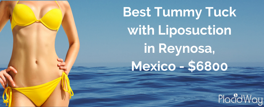 Tummy Tuck in Mexico with Liposuction