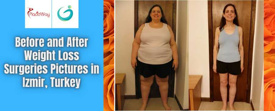 Weight Loss Surgery