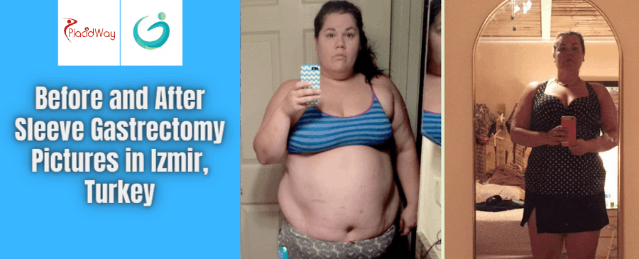Sleeve Gastrectomy