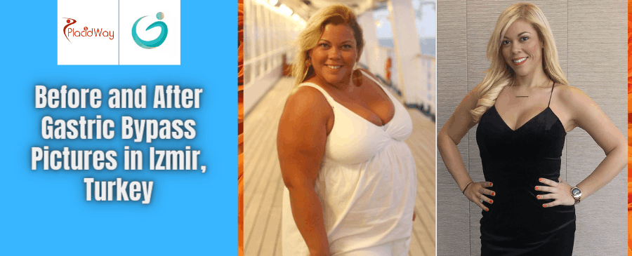 Gastric Bypass