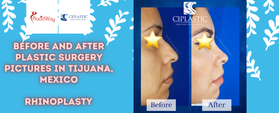 Before and After Rhinoplasty in Tijuana, Mexico