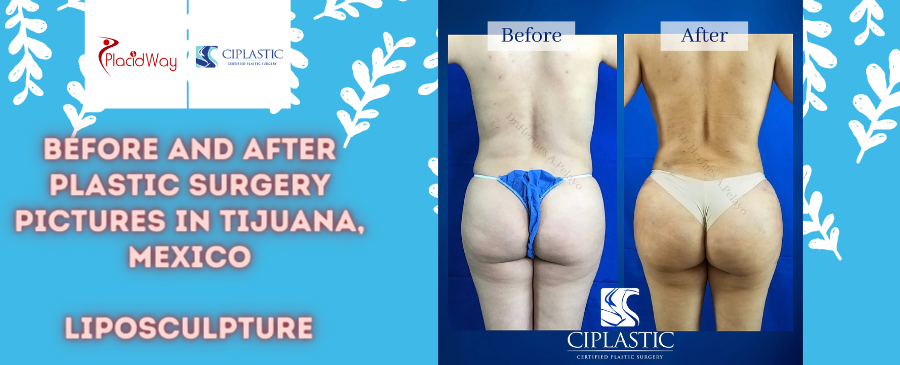 Before and After Liposculpture in Tijuana, Mexico