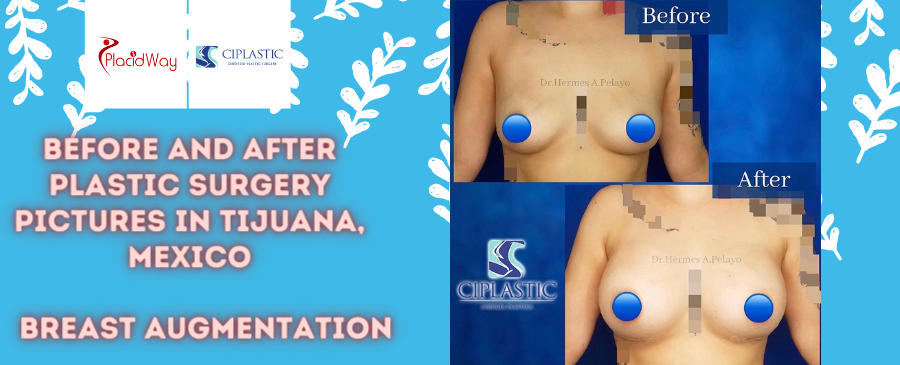 Before and After Breast Augmentation in Tijuana, Mexico