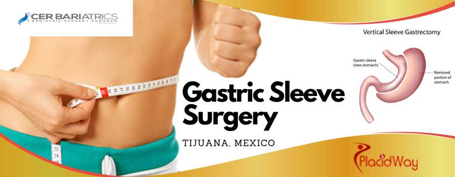 Gastric Sleeve Package in Tijuana, Mexico by CER
