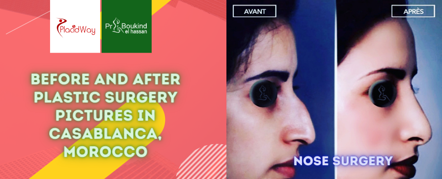 Before and After Plastic Surgery Pictures in Casablanca, Morocco