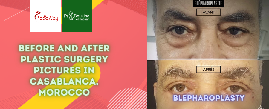 Before and After Plastic Surgery Pictures in Casablanca, Morocco