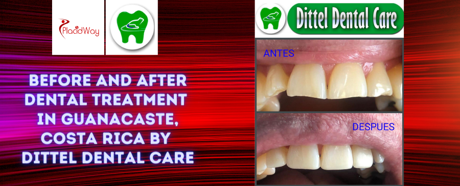 Before and After Dental Treatment Pictures in Guanacaste, Costa Rica
