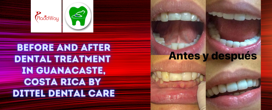 Before and After Dental Treatment Pictures in Guanacaste, Costa Rica