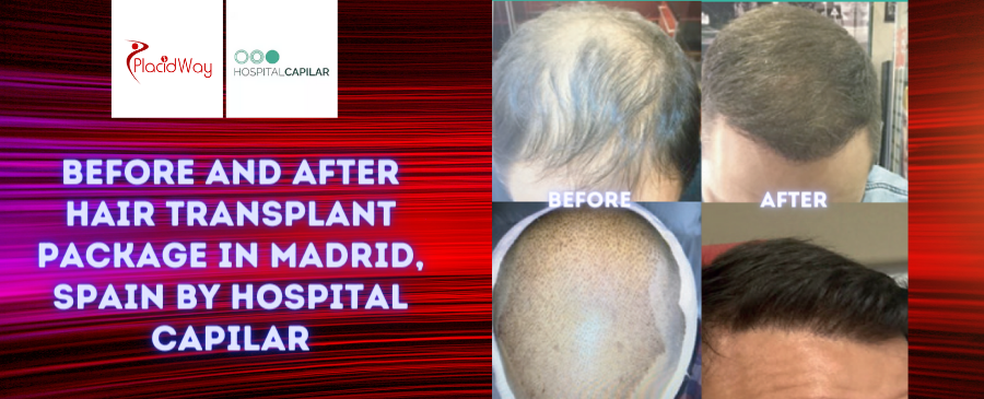 DHI Hair Transplant Package in Madrid, Spain by Hospital Capilar DHI Hair Transplant Package in Madrid, Spain by Hospital Capilar
