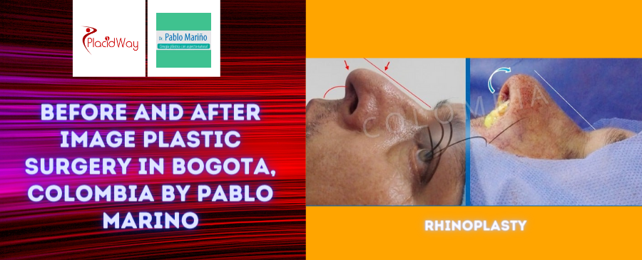 Before and After Image Plastic Surgery in Bogota, Colombia by Pablo Marino