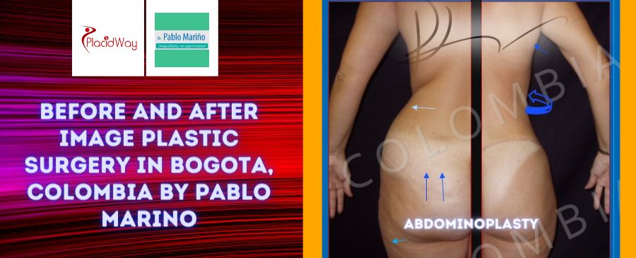 Before and After Image Plastic Surgery in Bogota, Colombia by Pablo Marino