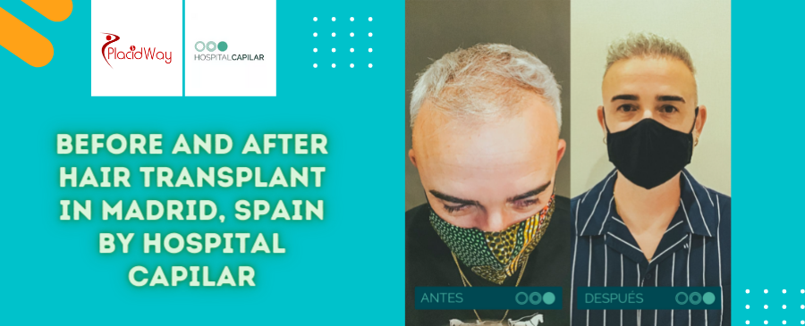 Before and After Hair Transplant Surgery in Madrid, Spain by Hospital Capilar