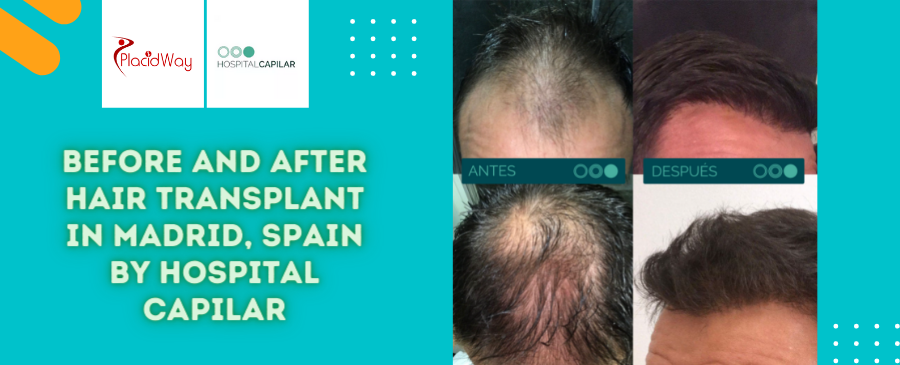 Before and After Hair Transplant Surgery in Madrid, Spain by Hospital Capilar