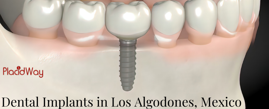 Dental Implants in Los Algodones, Mexico