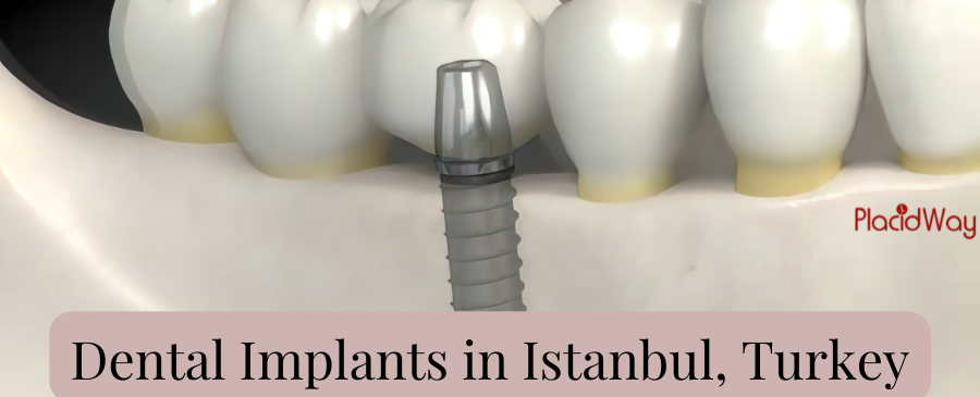 Dental Implants Turkey