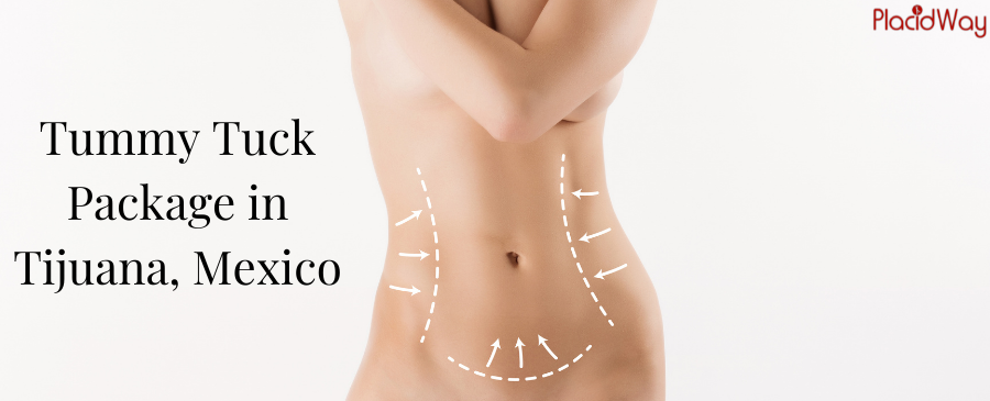 Tummy Tuck Package in Tijuana, Mexico