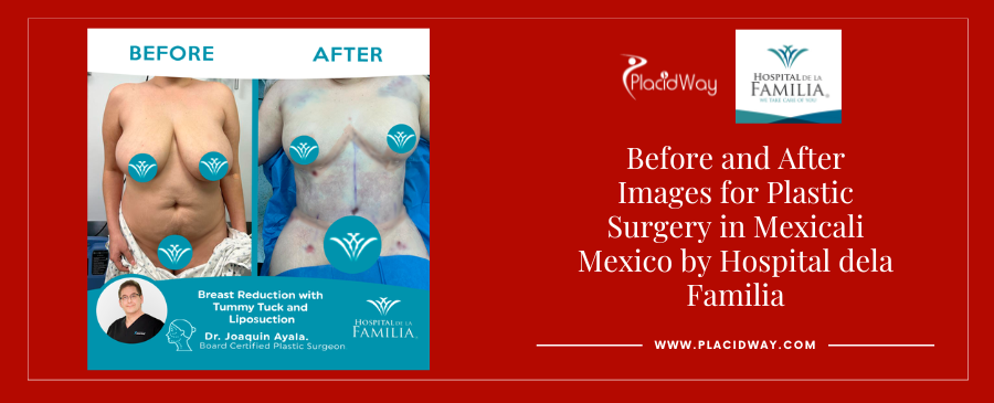 Before and After breast reduction in Mexicali, Mexico