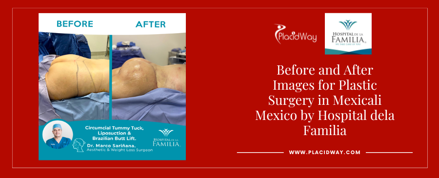 Before and After liposuction and bbl in Mexicali, Mexico