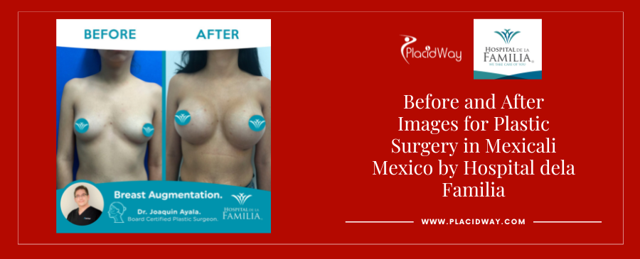 Before and After breast augmentation in Mexicali, Mexico