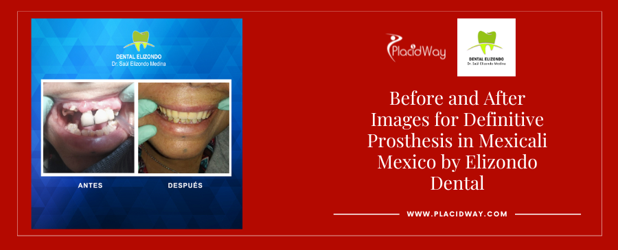 Before and After Pictures for Dental Care in Mexicali Mexico by EDG