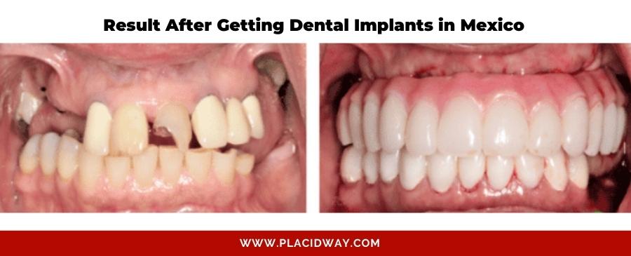 Dental Implants Mexico Before and After