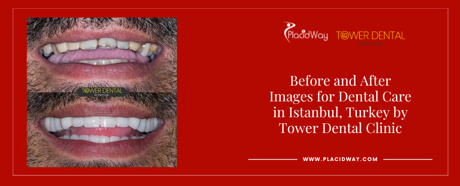 Before and After Dental Crowns in Istanbul Turkey