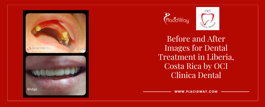 Before and After Images for Dental Treatment in Liberia, Costa Rica by OCI Clinica Dental