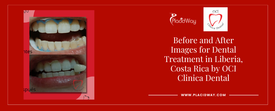 Before and After Images for Dental Treatment in Liberia, Costa Rica by OCI Clinica Dental