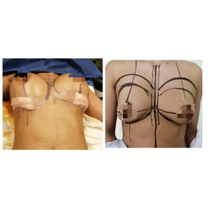 before after breast lift in Tijuana at Gilenis Surgical Center