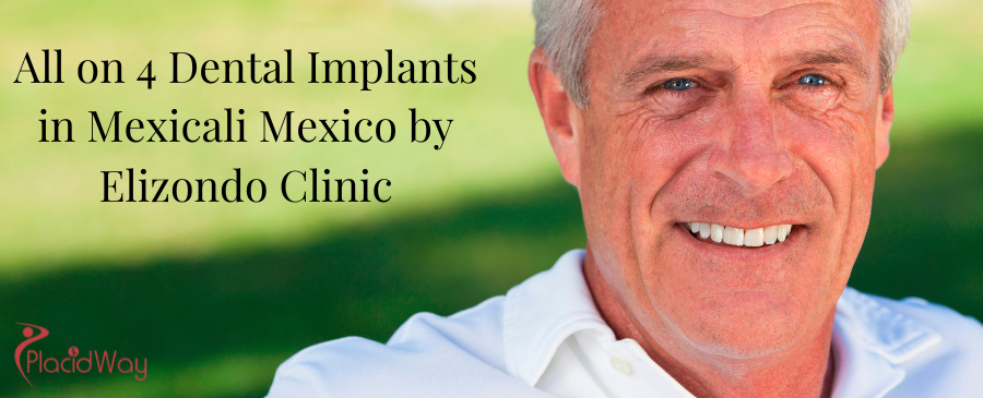 All on 4 Dental Implants in Mexicali Mexico