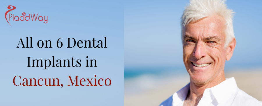 All-on-6 Dental Implants in Cancun, Mexico