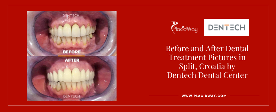 Before and After Dental Veneers in Split Croatia at Dentech Dental Centar