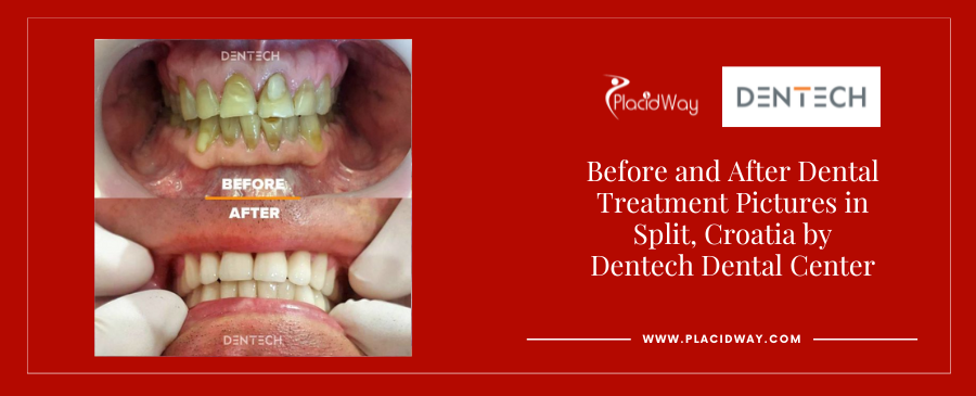 Before and After Smile Makeover in Split Croatia at Dentech Dental Centar