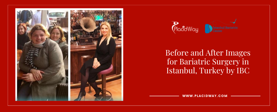 Before and After Images for Bariatric Surgery in Istanbul, Turkey