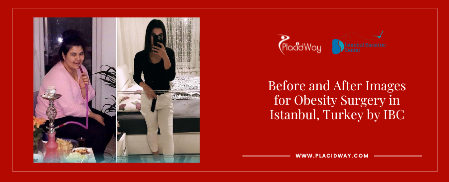 Before and After Images for Obesity Surgery in Istanbul, Turkey