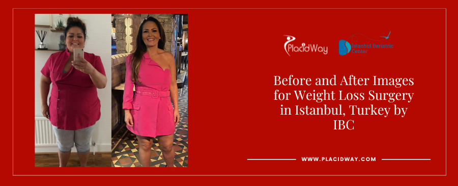 Before and After Images for Weight Loss Surgery in Istanbul, Turkey