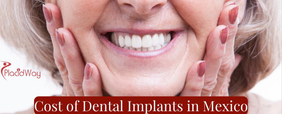 Cost of Dental Implants in Mexico