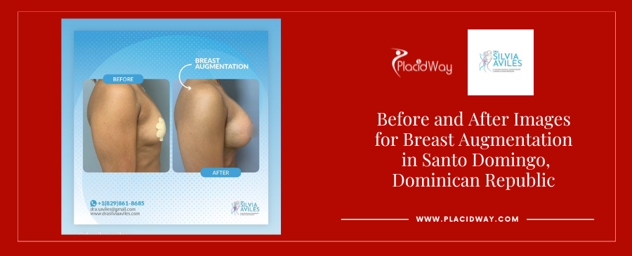 Breast Augmentation in Santo Domingo Dominican Republic Before and After