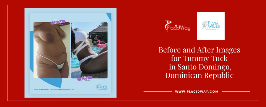 Tummy Tuck and Breast Augmentation in Santo Domingo Dominican Republic Before and After