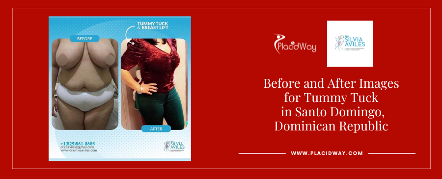 Tummy Tuck and Breast Lift in Santo Domingo Dominican Republic Before and After