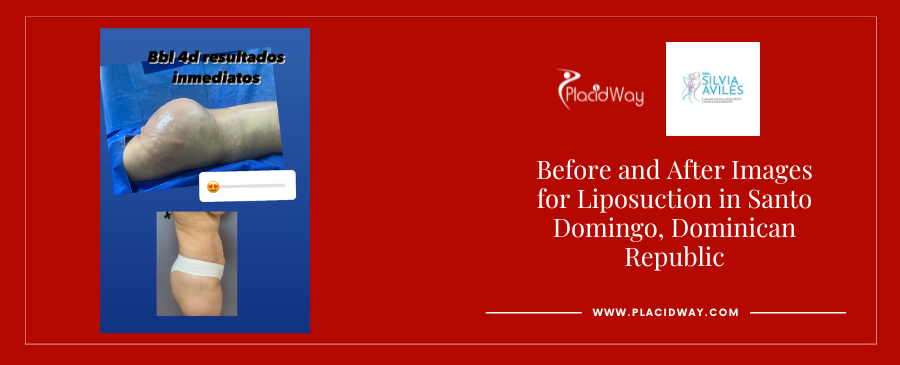 BBL and Liposuction in Santo Domingo Dominican Republic Before and After