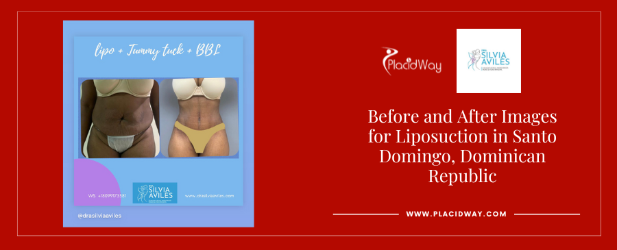 Lipo Surgery and Tummy Tuck in Santo Domingo Dominican Republic Before and After