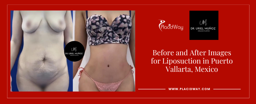 Before and After Liposuction in Puerto Vallarta Mexico