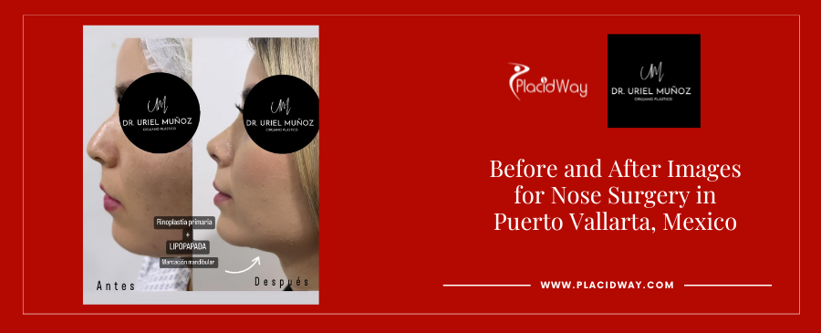 Before and After Liposuction in Puerto Vallarta Mexico